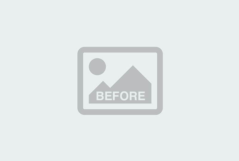 Before Image: Acne Scar treatment on face - front