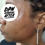 DPN removal after word swag
