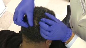NY1 hair loss story image