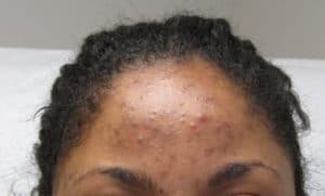 acne with hyperpigmentation