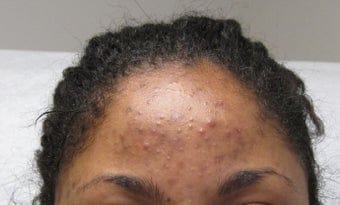 hair fall dermatologist near me