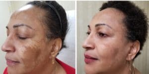 Vi peel before and after melasma 1 month 300x150 1