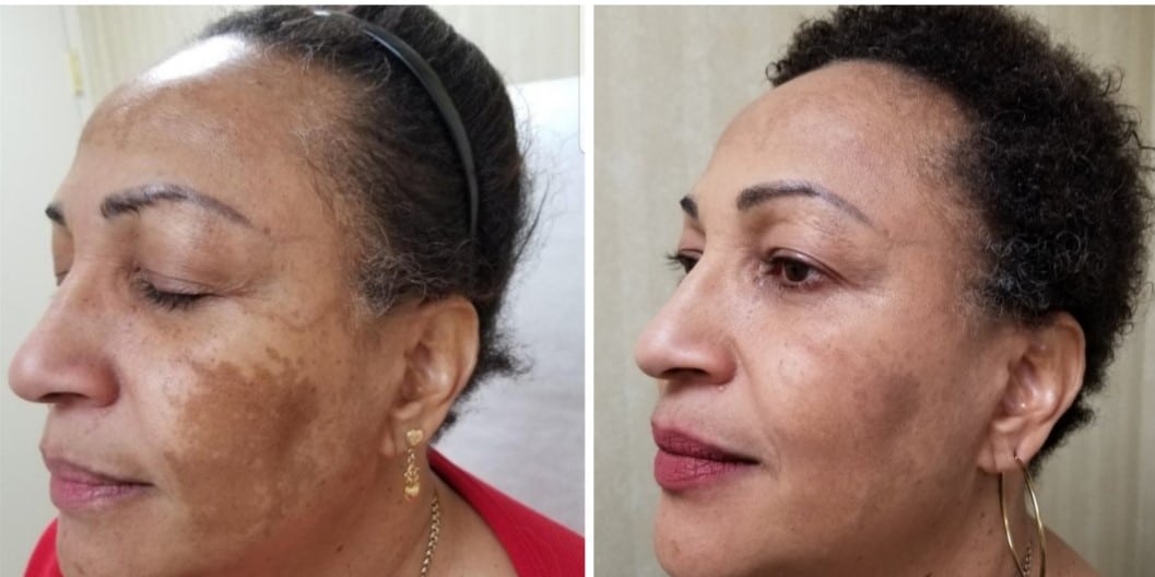 Chemical Peel Before & After