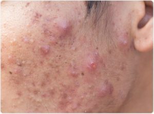 teen acne cheek