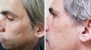 older man before and after Cutera Secret RF acne scar treatment with smoother skin after procedure