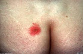 Genital herpes sometimes presents instead on the buttocks