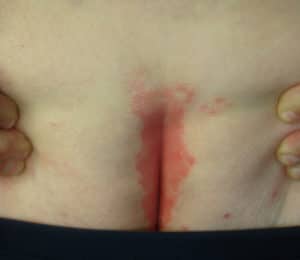 psoriasis butt rash