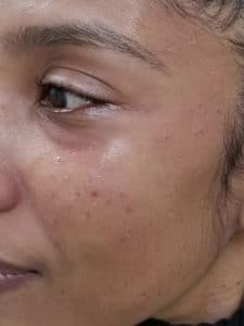 After Image: DPN Removal before and after