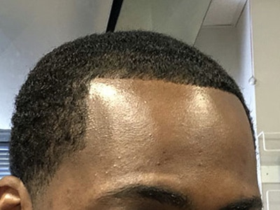 After Image: Depigmentation - right-front-oblique