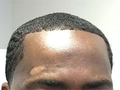 Before Image: Depigmentation - right-front-oblique