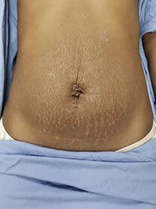 After Image: Skin tightening before and after