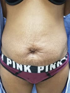Before Image: Skin tightening before and after