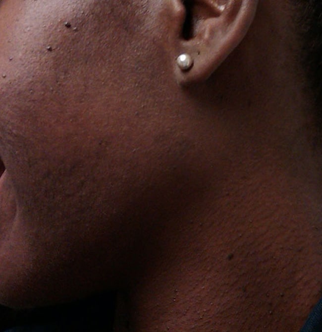 After Image: Acne before and after - left-side