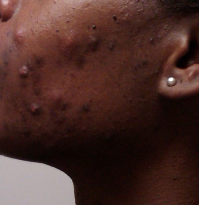 Before Image: Acne before and after - left-side