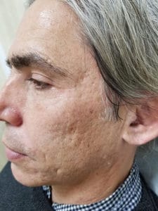 Before Image: Acne scar treatment before and after