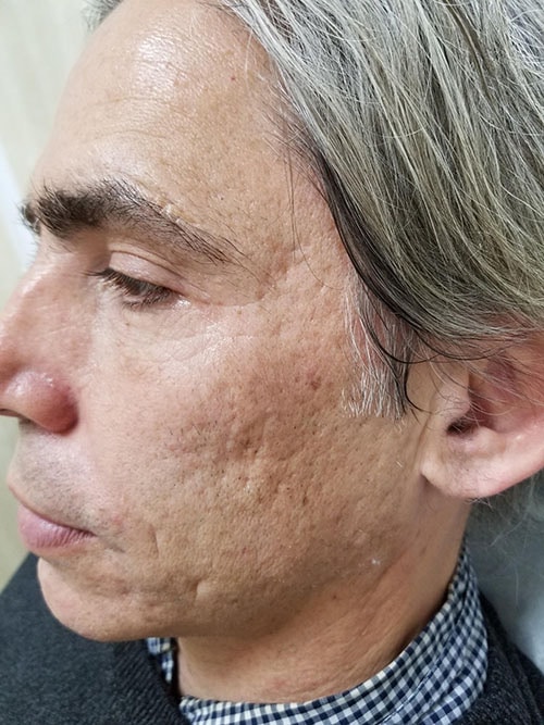 Before Image: Acne scar treatment before and after - left-front-oblique