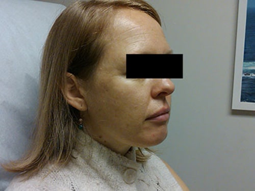 After Image: Jessner’s peel before and after - right-front-oblique