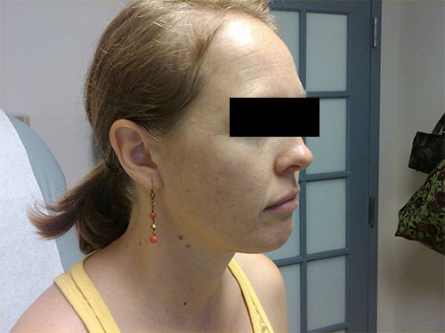 Before Image: Jessner’s peel before and after - right-front-oblique