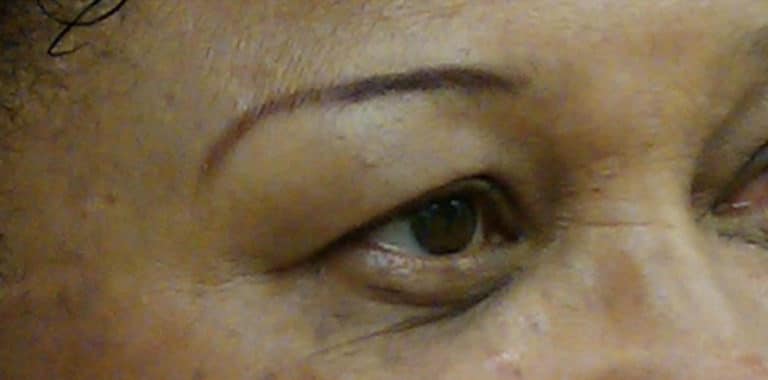 After Image: Treatment for Removal of Dark Circles - right-front-oblique