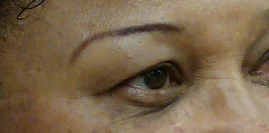 After Image: dark circles around eyes before and after - right-front-oblique