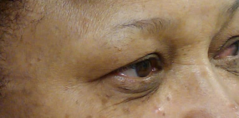 Before Image: Treatment for Removal of Dark Circles - right-front-oblique