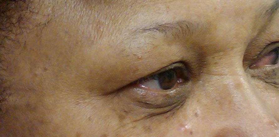 Before Image: dark circles around eyes before and after - right-front-oblique