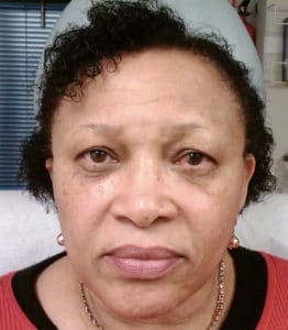 Before Image: Dark Circle Removal Treatment