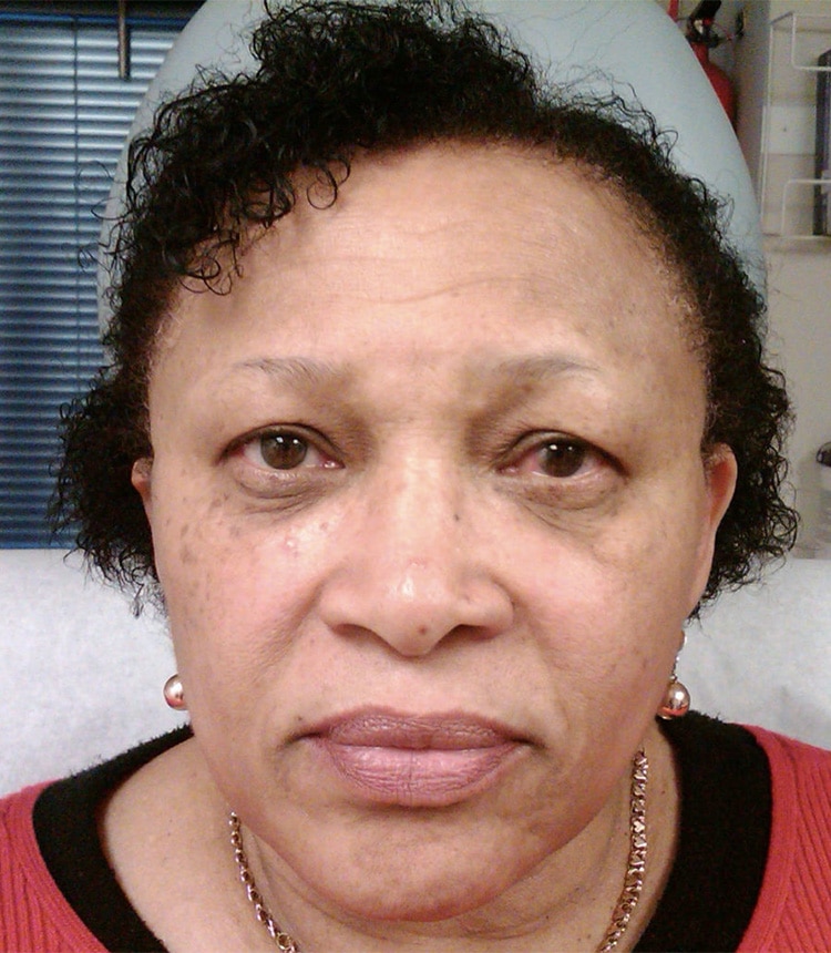 Before Image: Dark Circle Removal Treatment - front