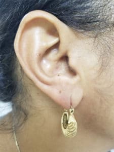 After Image: Earlobe Filler