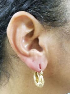 Before Image: Earlobe Filler