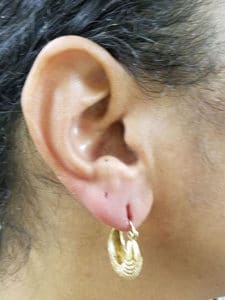 Earlobe Filler