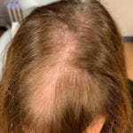 femalehairloss after c1