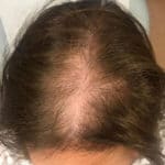 femalehairloss before c1