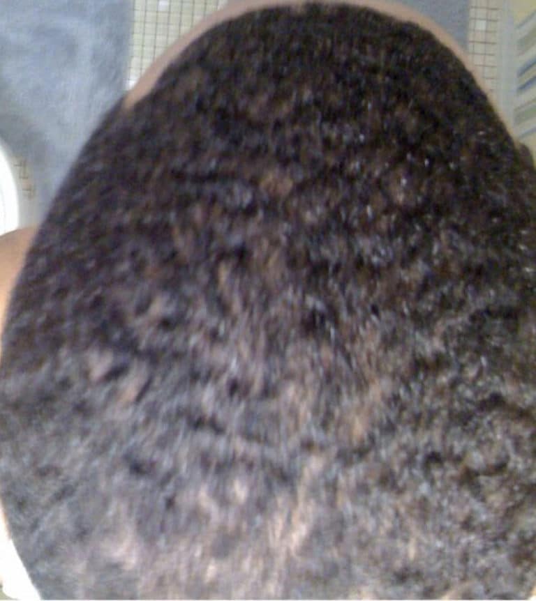 After Image: Folliculitis Decalvans - front