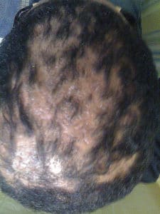 hairloss treatment FC c1 before1
