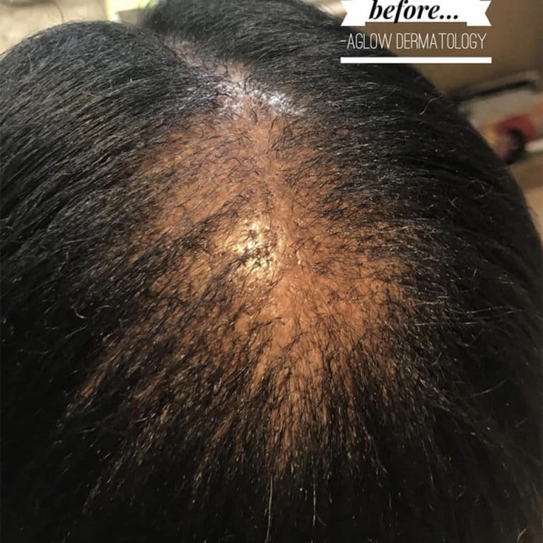 Before Image: Before and after CCCA alopecia - front