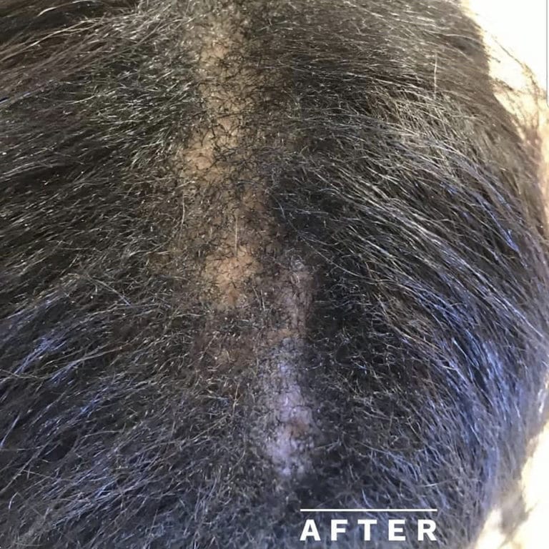 After Image: Before and after CCCA alopecia - front