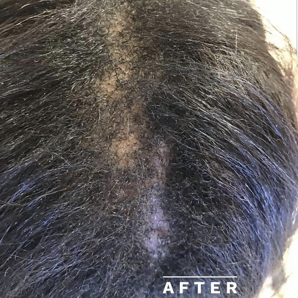 After Image: Before and after CCCA alopecia - front