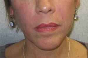After Image: Juvederm Ultra Plus