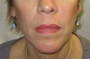 Before Image: Juvederm Ultra Plus