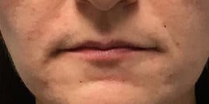 After Image: Juvederm Ultra Plus