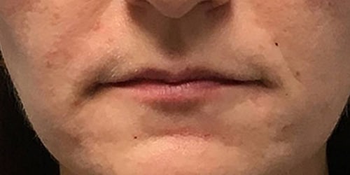 After Image: Juvederm Ultra Plus - front