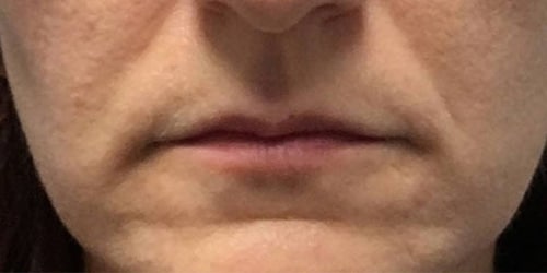 Before Image: Juvederm Ultra Plus - front