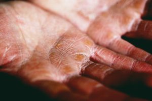 eczema flares up