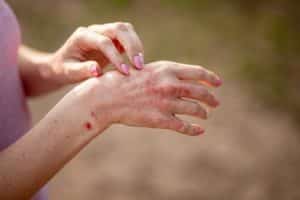 ill allergic rash eczema skin of patients hand