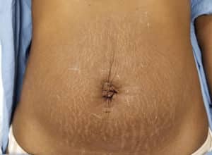 After Image: Stretch Mark Removal