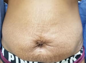 Before Image: Stretch Mark Removal