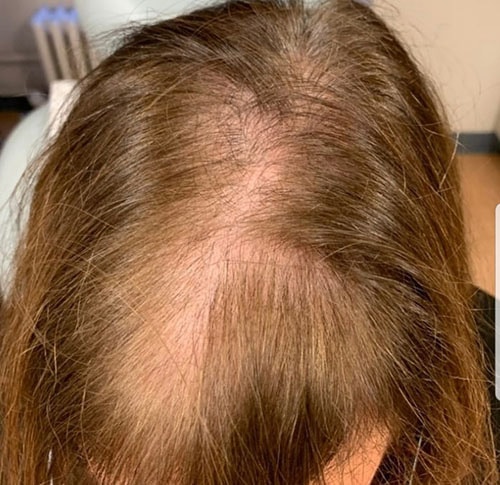 femalehairloss after c1