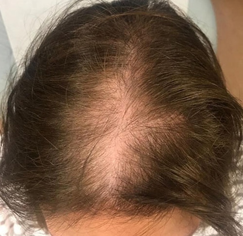 femalehairloss before c1