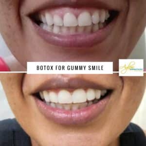 Botox for gummy smile before and after